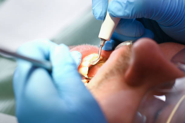 Best Emergency Wisdom Teeth Removal in Lebanon, VA